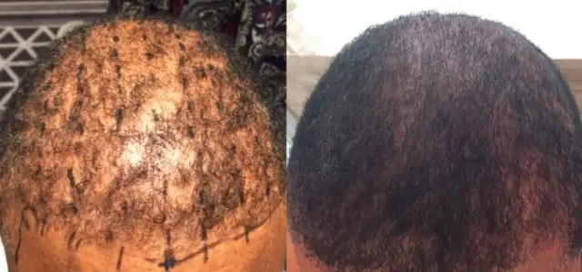 Before | After Photo after PRP-A Hair Loss Treatment after (4) Months