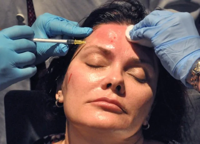 Hands-On Training for PRP Facial Rejuvenation