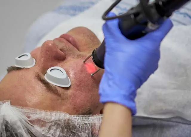 Acne Scar Patient utilizing Fractional CO2 Laser Treatments