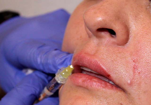 Workshop Photo of Belotero Balance Filler Lip Plumping Injection