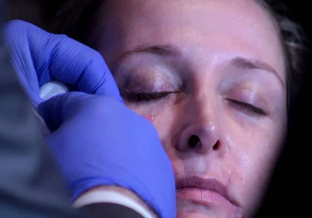 Tear Trough Injection during Hands-On-Training using HA Fillers