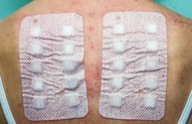 Dermal Patch Allergy Test for Contact Dermatitis at Allergy Training Session