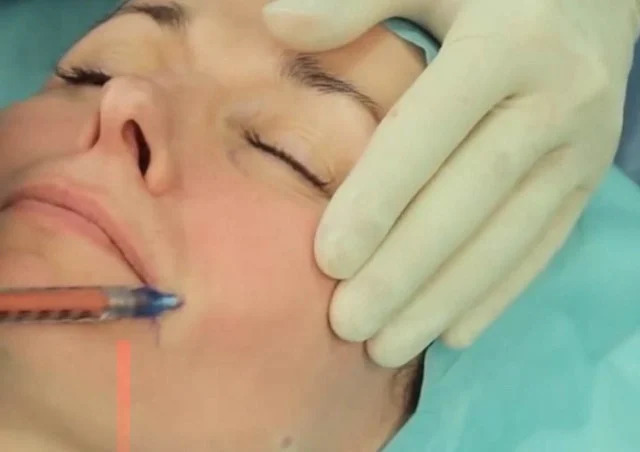 Fat Transfer Reinjection Technique