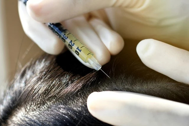 PRP Hair Loss Treatment Training