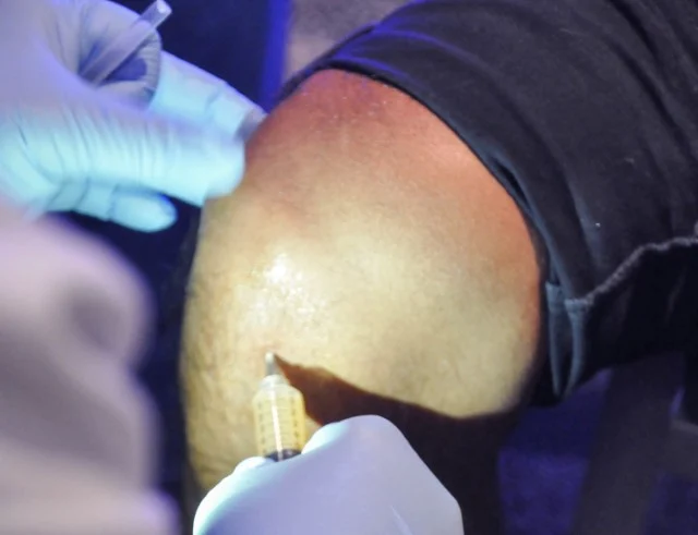 Demonstration of Intra-patellar Injection with P-PRP