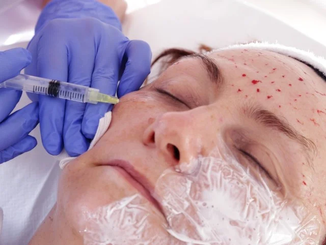 Mesotherapy injections for the Meso-Lift Procedure