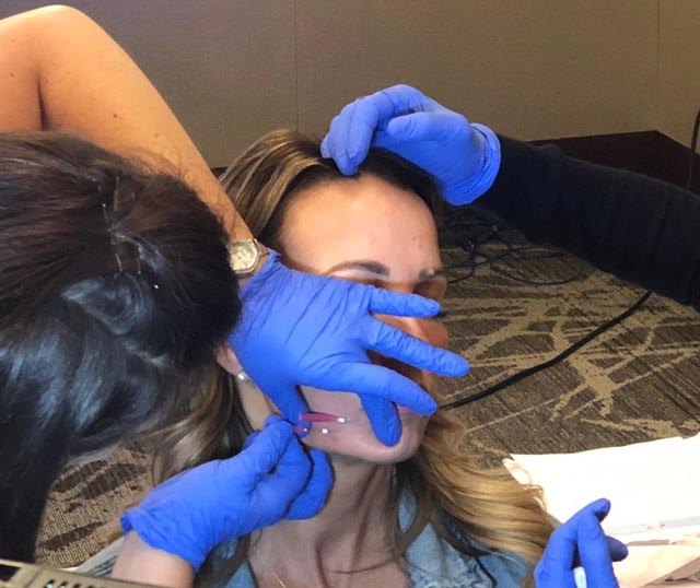 PDO Thread Lift Training