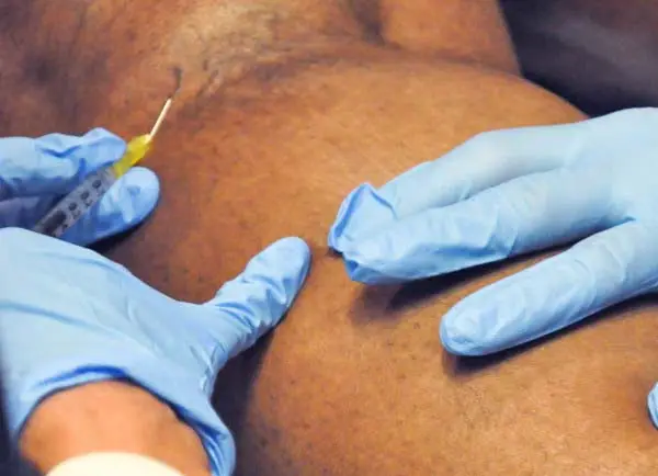 Live Practical Session: Cosmetic Sclerotherapy Training