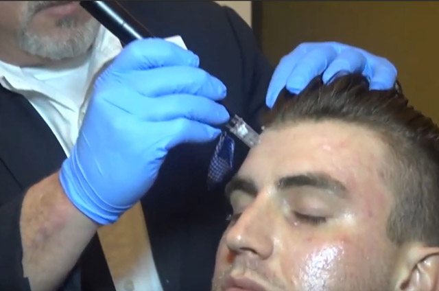 Practical Live Session Microneedling