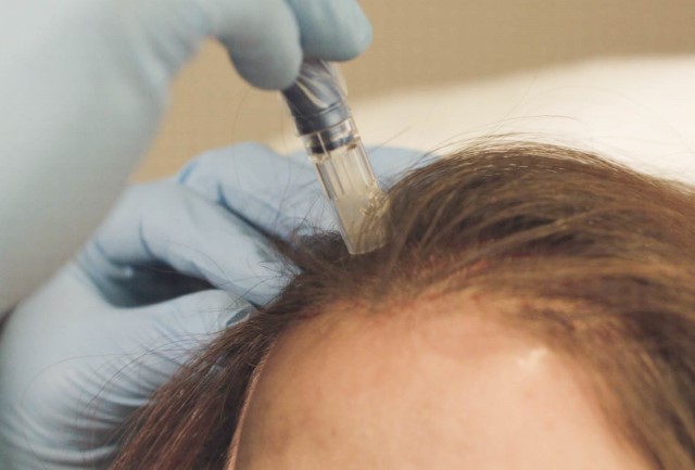 Combination Treatment using MicroNeedling and PRP-A for Alopecia Patient