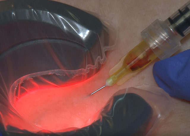 sclerotherapy training treatment using 1064nm Nd Yag Laser